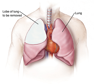 Illustration of a lobectomy