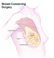 Illustration that explains breast-conserving surgery