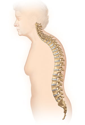Side view of body showing spine with kyphosis causing hump in upper back.