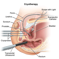 Cryotherapy procedure