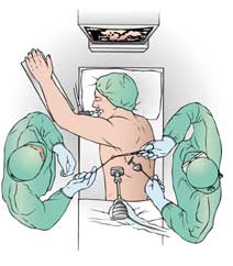 thoracotomy