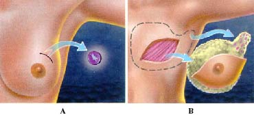 lumpectomy and mastectomy