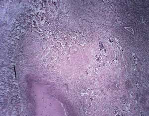 lung carcinoma