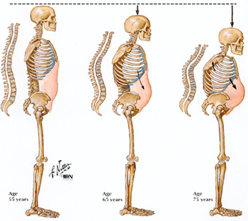 Image of three female skeletons illustrating osteoporosis at ages 55, 65, and 75 years.