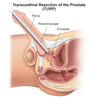 Illustration of transurethral resection of the prostate (TURP)