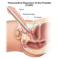 Click Image to Enlarge Illustration of transurethral resection of the prostate (TURP)